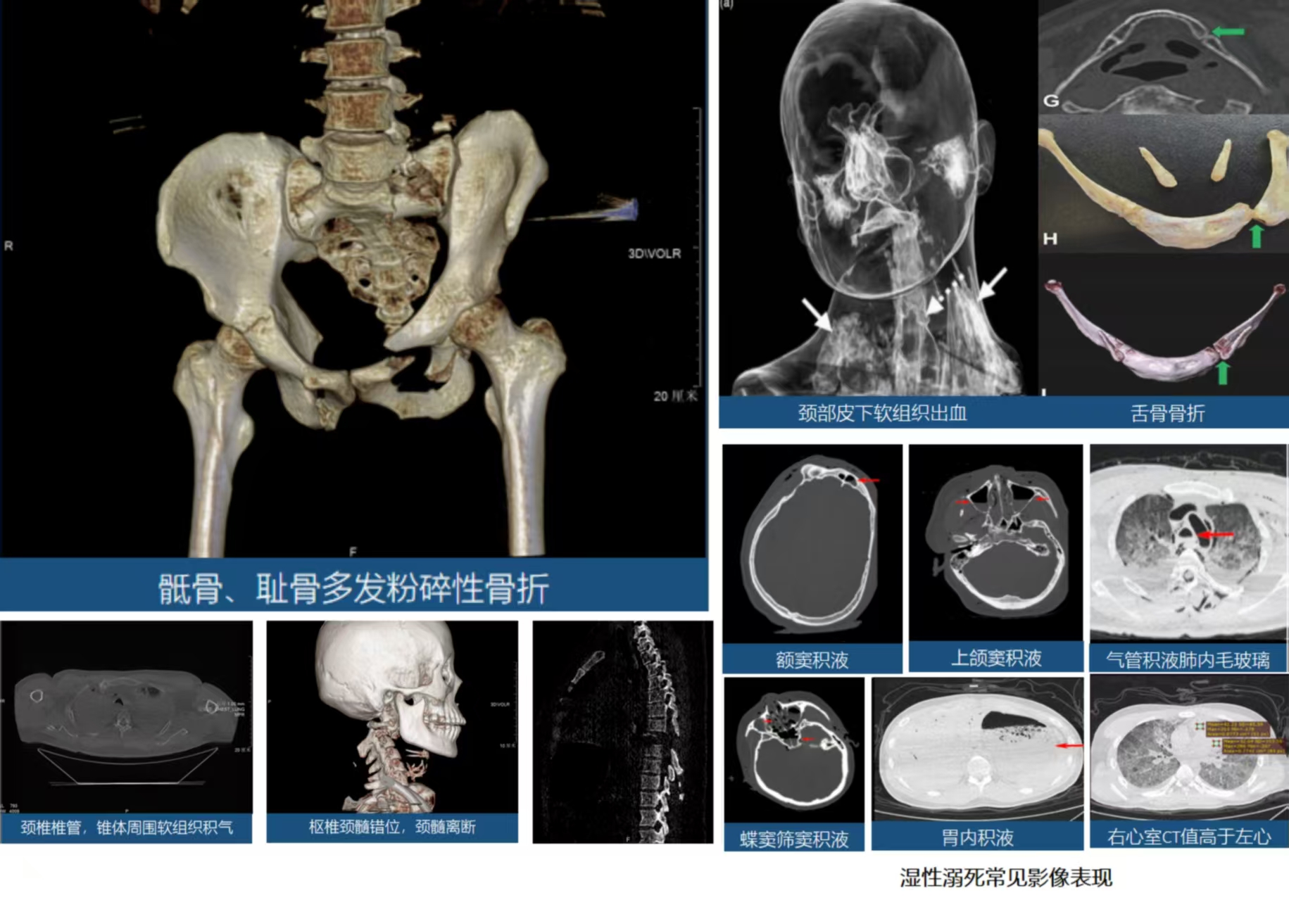 当尸体经过法医的手，“他”还能剩下什么？（法医检验后人体还能剩下什么？）虚拟解剖的优势和人文关怀。
